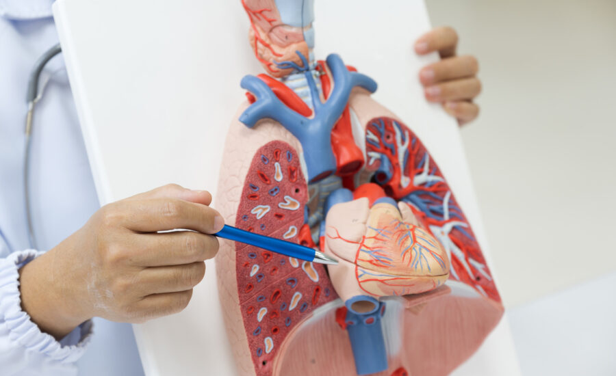 bypass coronarico quando